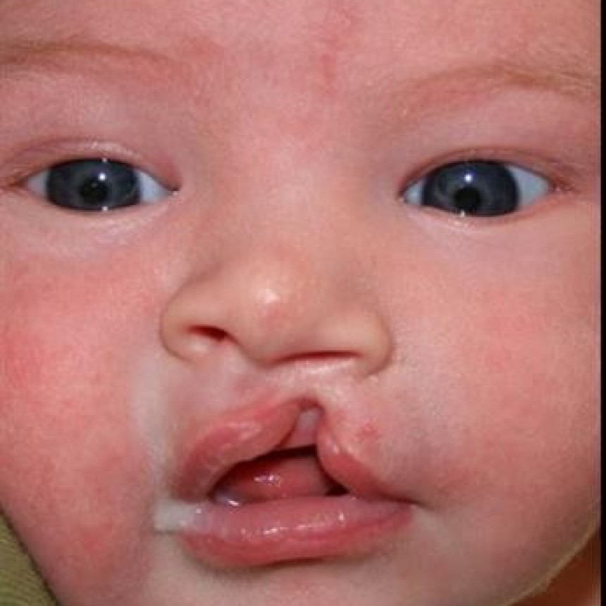 Atención gratuita para niños con labio leporino